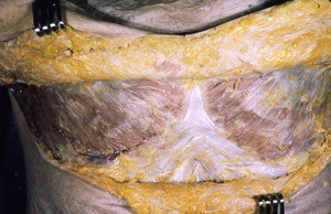 Natural color photograph of dissection of the thorax, anterior view, with the skin retracted to expose the pectoralis major muscles
