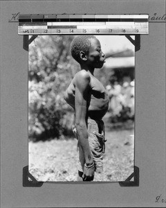 African man suffering from spinal tuberculosis, Nyasa, Tanzania, 1929