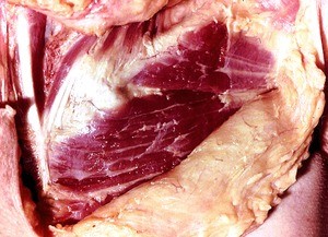 Natural color photograph of dissection of the thoracic wall, anterior view, showing the left clavicle and left pectoralis major m