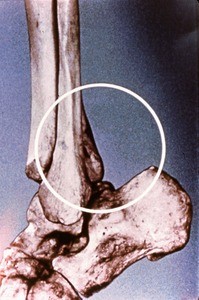 Illustration of bones of left ankle joint, lateral view