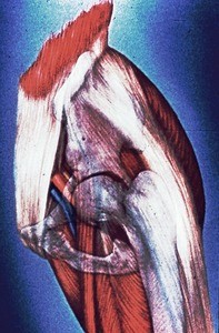 Illustration of dissection of anterolateral view of left hip joint with bony parts ghosted in