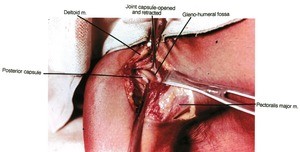 Natural color photograph of a dissection of the right glenohumeral joint, anterior view, with the joint capusle opened and retracted to expose the glenoid fossa