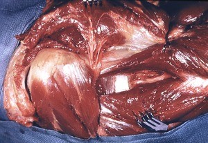 Natural color photograph of dissection of the right shoulder, lateral view, with the deltoid and pectoralis major reflected to expose the muscle structure of the upper arm and shoulder