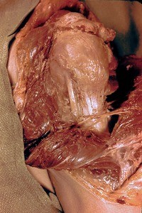 Natural color photograph of dissection of the left shoulder, lateral view, with the deltoid muscle reflected to reveal the surgical neck of the humerus, the axillary nerve, and the tendon of the long head of the biceps brachii