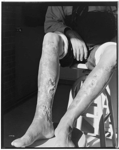 Legs of man with vericose veins