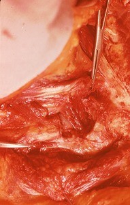 Natural color photograph of dissection of the neck, anterolateral view, with the right sternocleidomastoid m. cut and reflected, exposing major vessels beneath