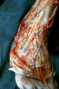 Natural color photograph of dissection of the dorsum of the right foot, showing superficial structures