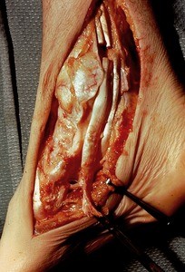 Natural color photograph of dissection of the right foot, medial view, with the tibialis posterior and flexor digitorum longus tendons severed