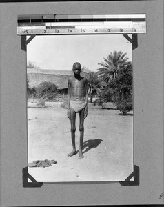African man suffering from sleeping sickness, Nyasa, Tanzania, 1929