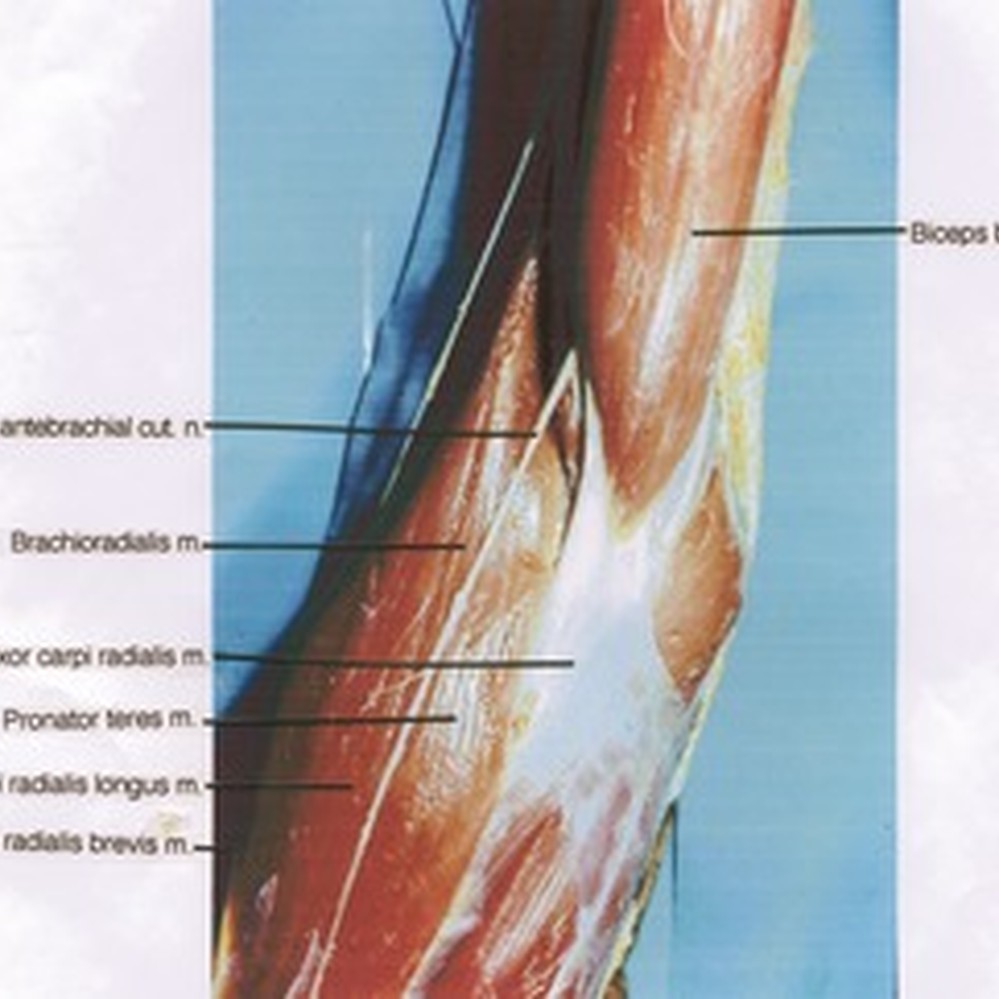 Natural color photograph of dissection of right cubital region,  antero-medial aspect, showing major superficial muscles of the forearm —  Calisphere, image size:999x999